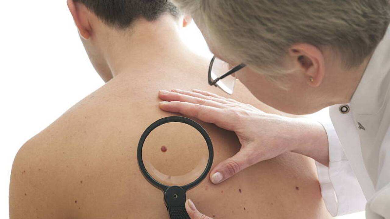 Melanoma Test