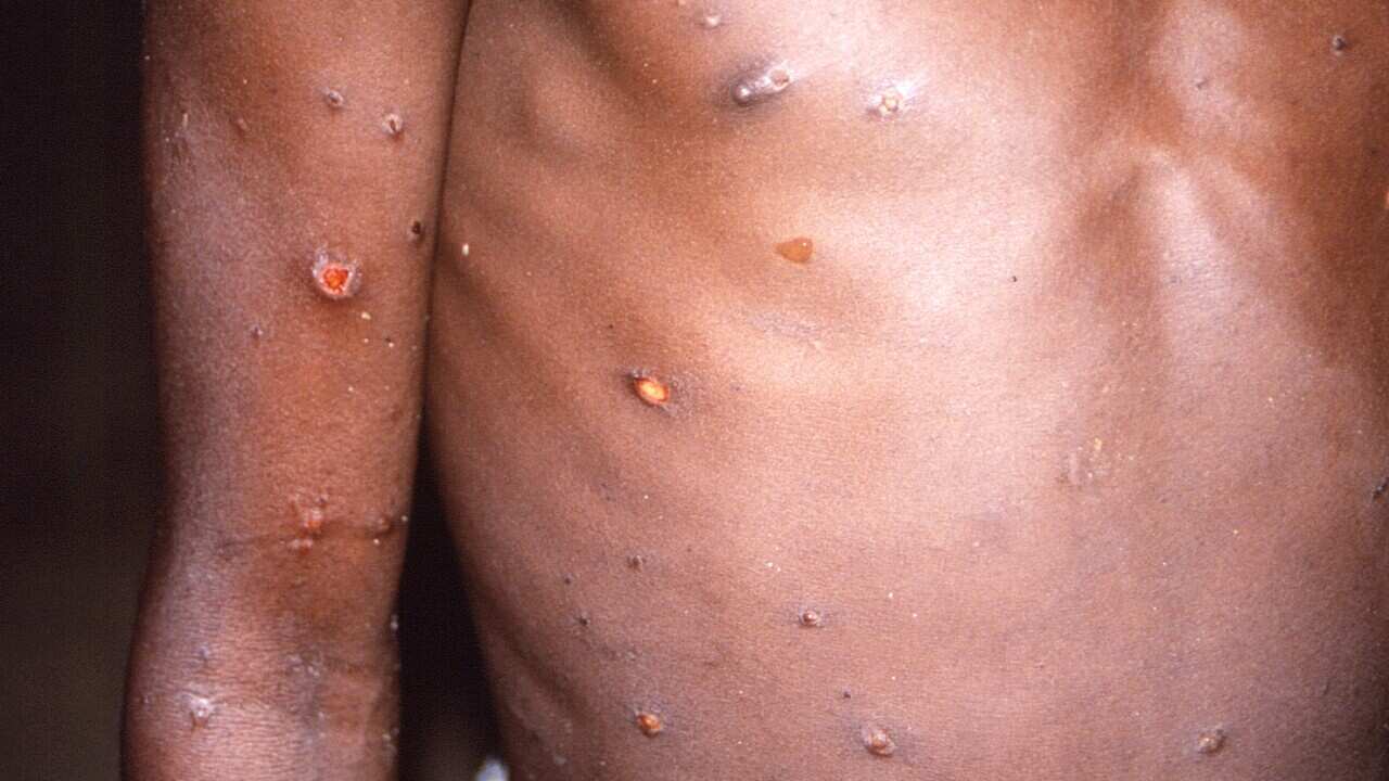  Signs of monkey pox